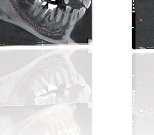 IMPLANT PLANNING Implant planning is so intuitive and fast that you can explain to your