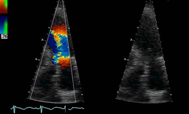 Moderate aortic regurgitation CASE