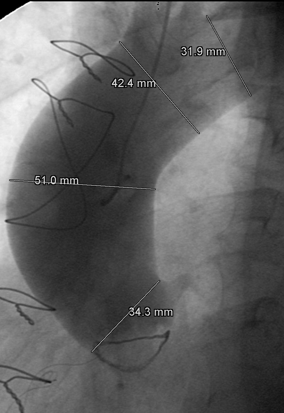5 cm should be considered for concomitant repair of the aortic