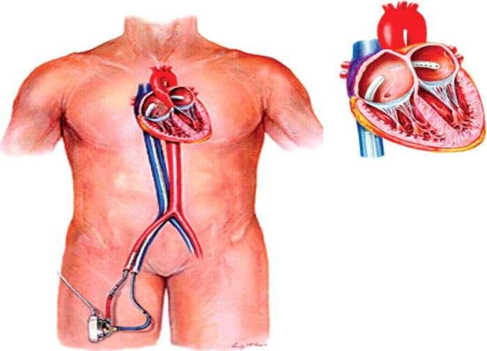 Tandem Heart plvad Left atrial-to-femoral