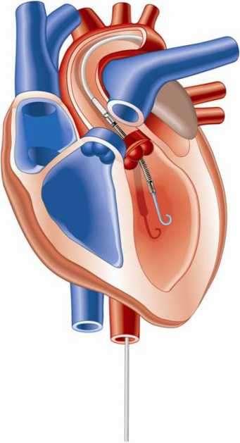 Impella Axial flow pump Much simpler to use Increases cardiac output & unloads LV LP 2.