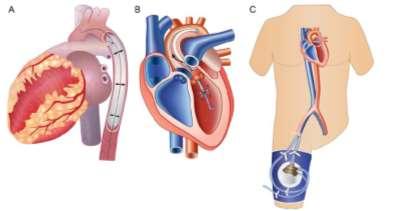 LVAD or IABP?