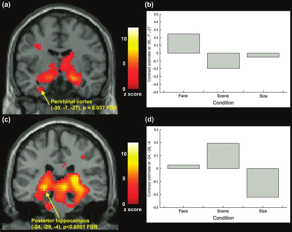 Lee Figure 3. (a) Significant regions of activity when the size oddity condition was subtracted from the face oddity task, superimposed on a coronal slice of a standard MNI brain template.