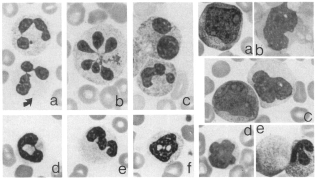Peripheral blood leukocyte morphologic characteristics after high-dose cytotoxic chemotherapy and rh-gcsf. A. Immature myeloid cell with blast-stage nuclear myelocytic-stage cytoplasmic maturation. B.