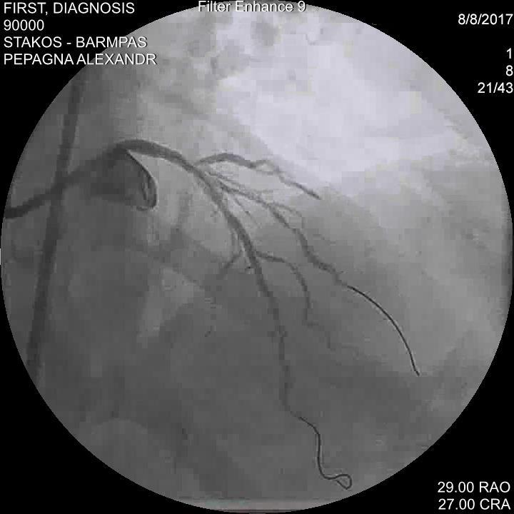 Coronary angiography revealed a small dissection (Type A) of the LAD and of the diagonal