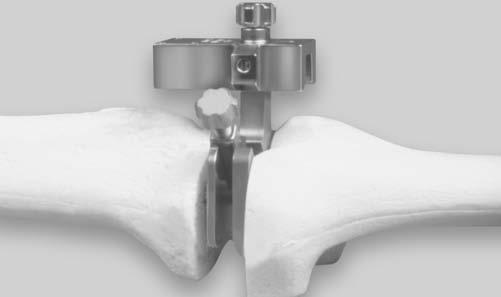 However, creating the femoral slot can be an important adjunct to proper rotational alignment and may facilitate more rapid arthrodesis by allowing for placement of a bridging bone graft anteriorly