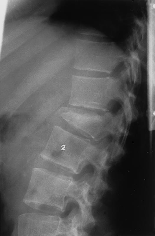 5 Sgittl T1-weighted () nd T2-weighted () MR scns of post-trumtic epidurl hemtom (rrows); sttus following