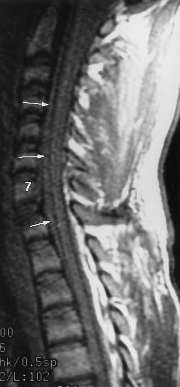 Trum (lunt trum, spinl mnipultion) is the most common cuse of hed/neck vsculr dissection, though