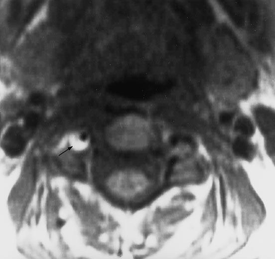 136 Fig. 6, Post-trumtic right verterl rtery dissection. High signl ªcrescentº sign representing hemtom in the wll of the RVA is seen (rrow) on n xil T1-weighted MR scn ().