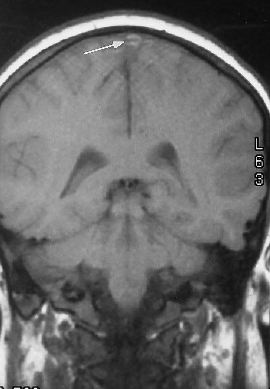 137 c Fig. 8 Acute superior sgittl sinus thromosis (rrows) demonstrting the ªdeltº sign on non-contrst coronl T1-weighted MR () nd the ªempty deltº sign on contrst-enhnced coronl T1- weighted MR ().