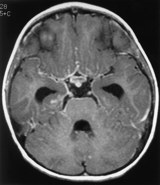 11 Temporl loe herpes simplex encephlitis (rrows) might e suspected on the CT scn (), ut is drmticlly demonstrted (hemorrhgic) on the non-contrst T1-weighted MR scn () As with rteril dissections,