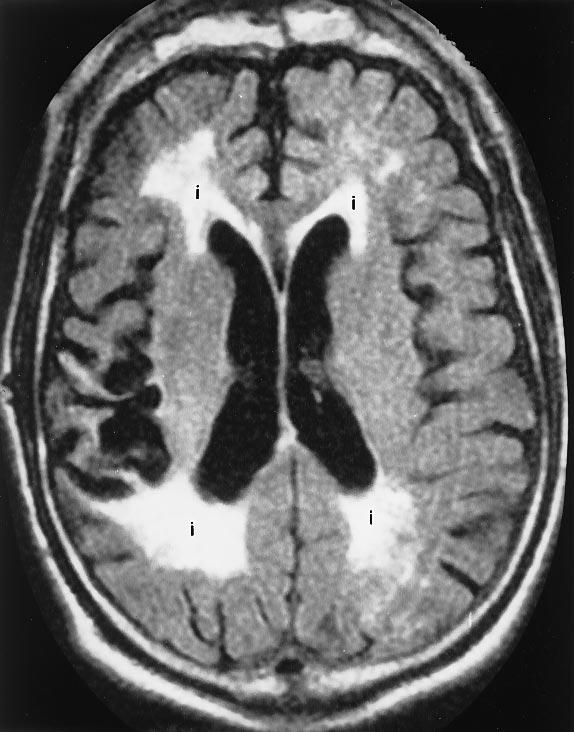(c). Also note the chronic ischemic chnges (i) on the FLAIR nd T2-weighted scns which re poorly seen on the diffusion imging ischemi nd non-vsculr cuses of stroke symptoms (such s mss effect nd/or