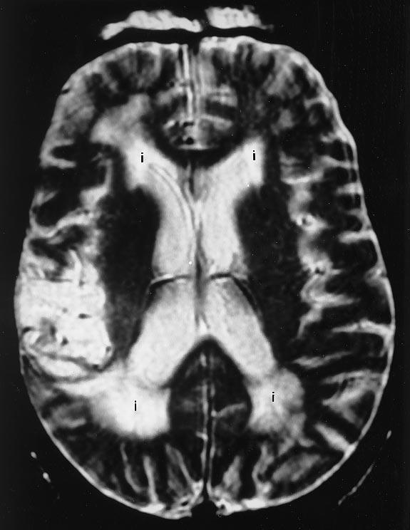 cererl ischemi. Diffusion-weighted (DW) MR imging hs lredy proven to e vlule in the emergency room setting for the evlution of suspected cererl infrction.