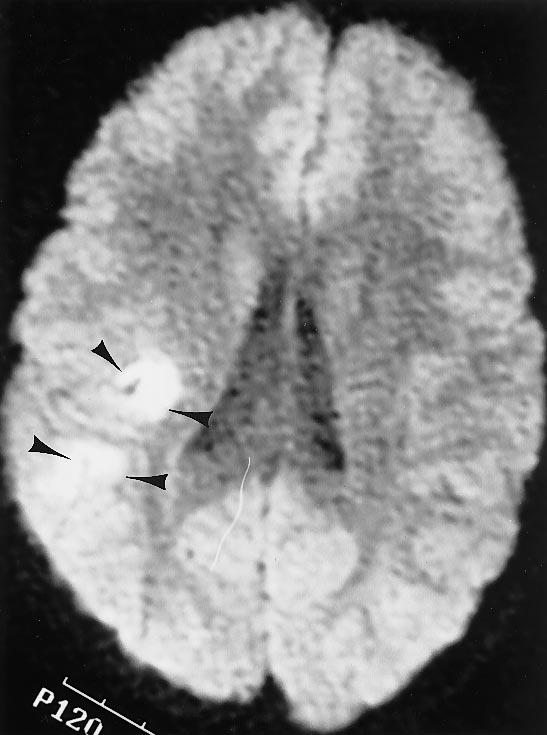 140 Fig. 14 ±e An 11-yer-old ptient with cute onset of left hemipresis.