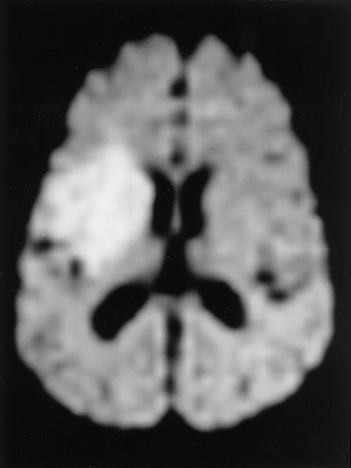 141 c Fig. 15 ±c A 30-yer-old ptient 3 dys fter repir of n ASD with cute onset of left hemipresis.