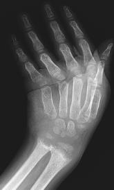 rachitic changes of distal radius and