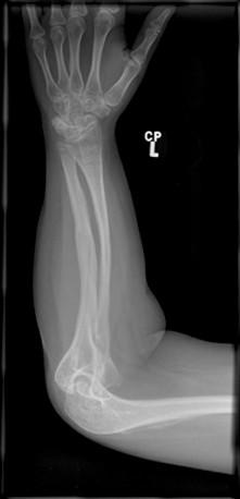 Figure 6. Frntal Radigraph f the frearm f a female adlescent with type I (mild) OI which shws steprsis, bwing defrmities, a healed ulnar fracture and grwth recvery lines in the distal radius.