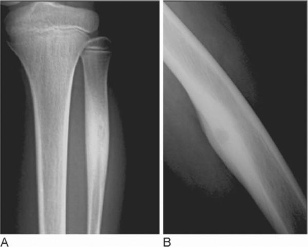 Figure 3. Radigraph f a 4 year ld girl with rickets and bwing f the legs. (Image frm Rijn R, McHugh K. Rickets Imaging.