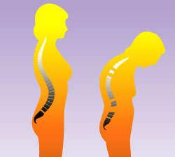 Guidelines for Screening for Osteoporosis in Women National Osteoporosis Foundation 2008 North American Menopause Association 2010 USPSTF 2001 Screen all women > 65 years regardless of risk Screen