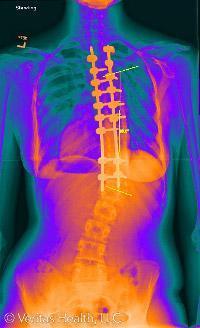 There are three general categories for scoliosis surgery. There s spinal fusion which fuses two or more vertebrae so they grow together at the spinal joint and form a solid bone that no longer moves.