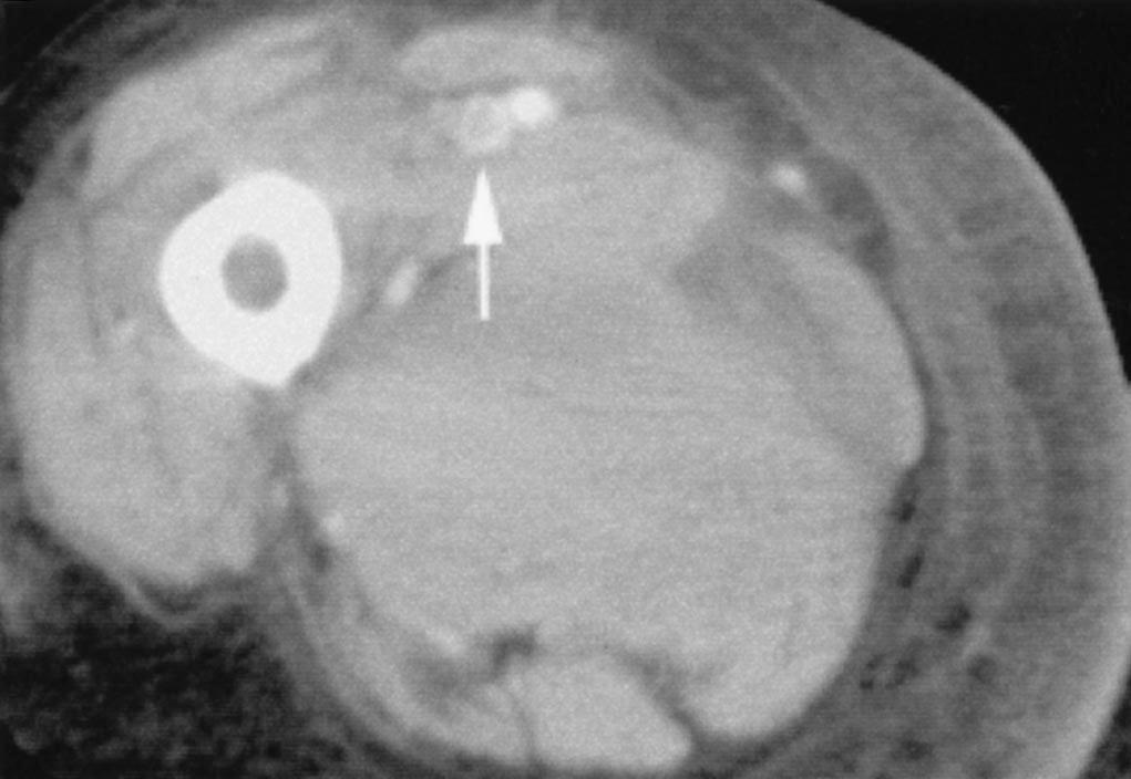 , CT venographic image shows extension of deep venous thrombosis into superficial femoral vein (arrow) after right femoral artery puncture complicated by large adductor compartment hematoma.