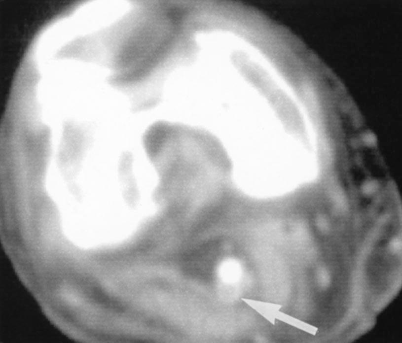 CT venographic image shows tiny, nonocclusive filling defect in right common femoral vein (arrow).