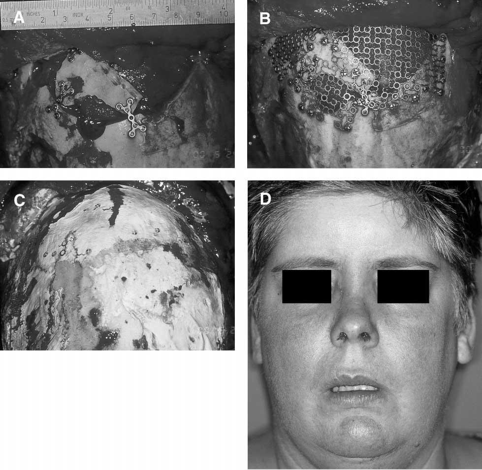 YADRANKO DUCIC 275 FIGURE 3. Patient with large frontal defect after excision of frontonasal esthesioneuroblastoma.
