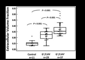 Pro-fibrotic changes Serum C-terminal propeptide of type I procollagen (PICP) is increased in G+/LVH-. Increased extracellular volume (ECV) on T1 MRI.