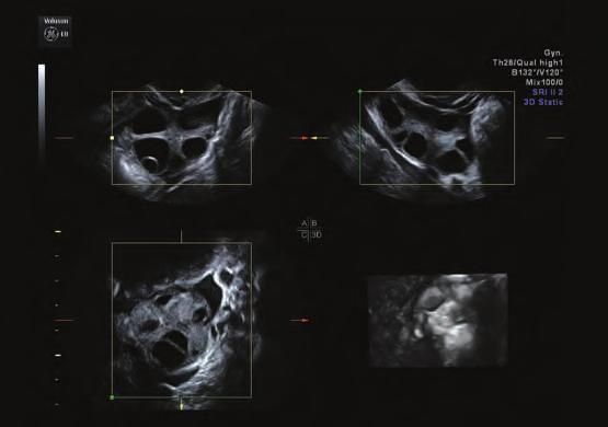 Introduction Historically, follicular assessment utilizing two-dimensional (2D) ultrasound imaging has been met with many challenges, inconsistencies and irregularity from user to user.