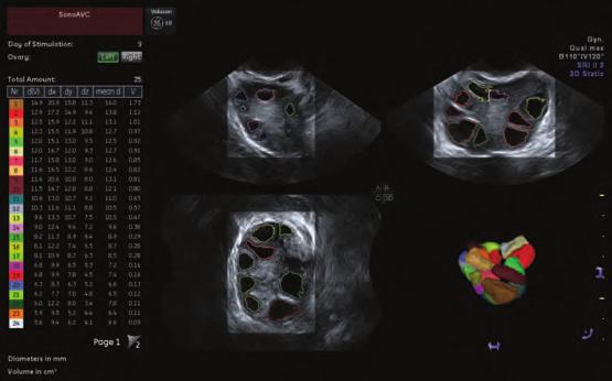 Volume imaging enables SonoAVC Volume Ultrasound is a method of acquiring an anatomical volume dataset.