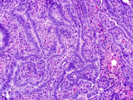 mg/ kg rat; cords lined with pleomorphic neoplastic cells.