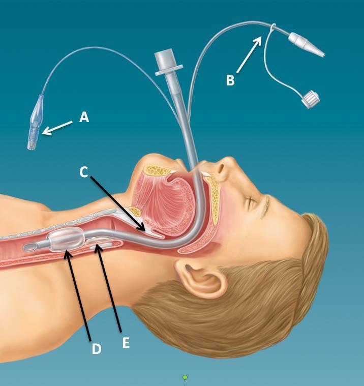 Appendix B: Figures Figure 1. Graphical representation of endotracheal tube placement and function. Hi-Lo Evac endotracheal tube illustrated.