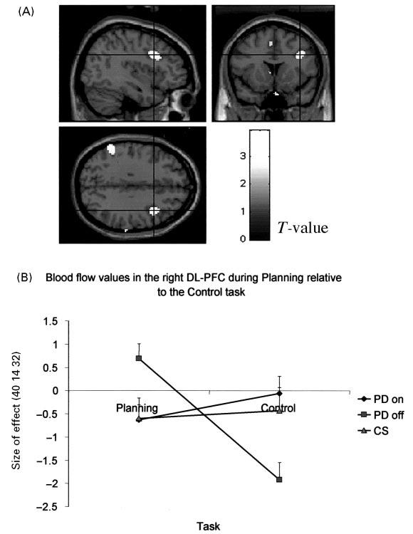 Dopaminergic modulation of prefrontal activity in Parkinson's disease 589 Fig.