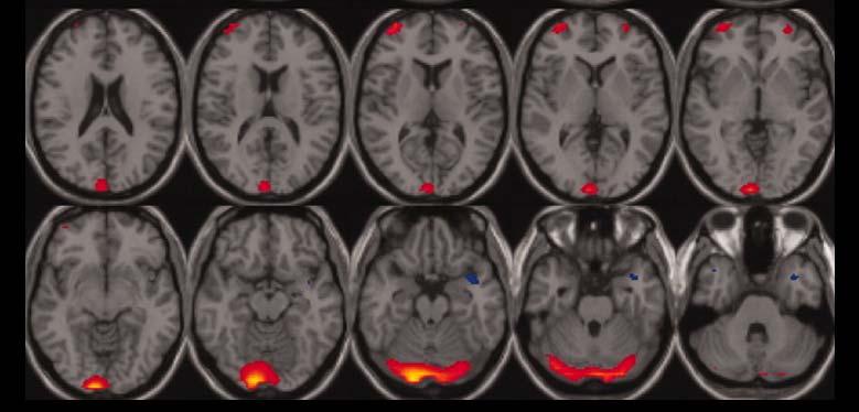 Example 1: SNP/fMRI Fusion Data Description: 20 Sz & 43 Healthy controls (Caucasian) fmri: one image per subject (Target activation in Auditory Oddball task SNP: one array per subject (384 SNP