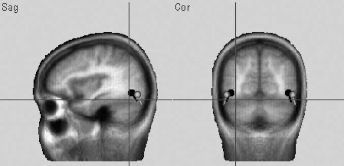 Figure 14. Source localizations for N250, based on difference waves (Block 4 minus Block 1) for semantic (black) and nonsemantic faces (gray), projected onto standard fmri.