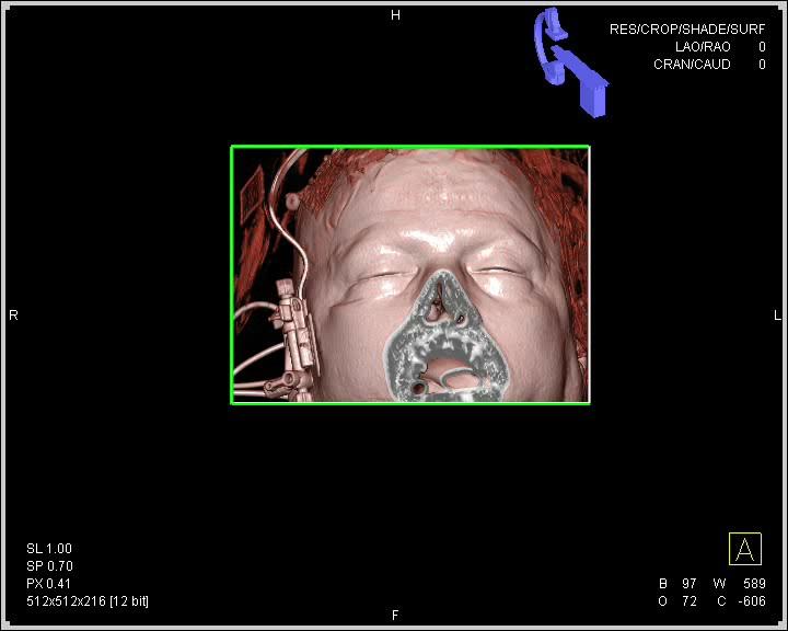 DECTA and DSA An important feature of DECTA is the possibility to search the MIP or VR images to find the visualization angle (described by spin and tilt parameters) that best depict the aneurysm,