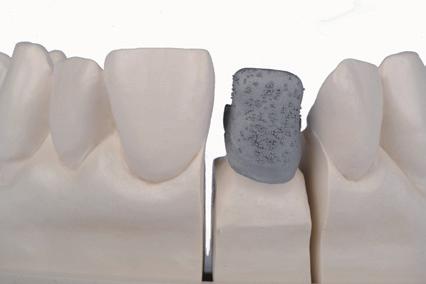 3-2. Layering technique for metal-supported restorations Translucent Incisal Body Opaque Cervical Translucent Opaque Cervical Incisal Body 1.