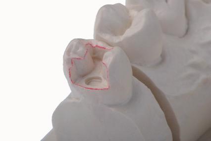 3. Application 3-4. Layering technique for inlays and onlays > 1.2 mm >1.0 mm Premolar >1.2 mm Molar >1.5 mm >1.2 mm >0.8 mm 1.