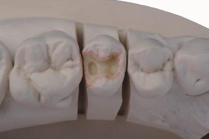Block out undercuts with blocking wax or blocking out resin and ensure that the restoration can be removed after polymerization process without damaging the die. 2.