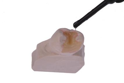 Make sure to provide space for subsequent application of Incisal and Incisal Effect materials. Complete the restoration by using Incisal and Incisal Effect materials (e.g. Occlusal).
