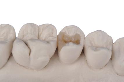 Case examples Pre-polish with DURA-POLISH on a brush with low pressure and a rotation speed of app.