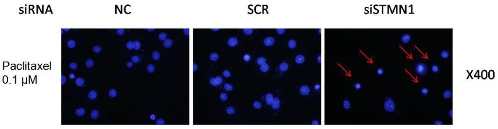 specific sirna to silence the expression of STMN1, compared with the nonspecific sirna group, the number of plate colonized esophageal squamous cell carcinoma Eca-109 cells treated with 0.