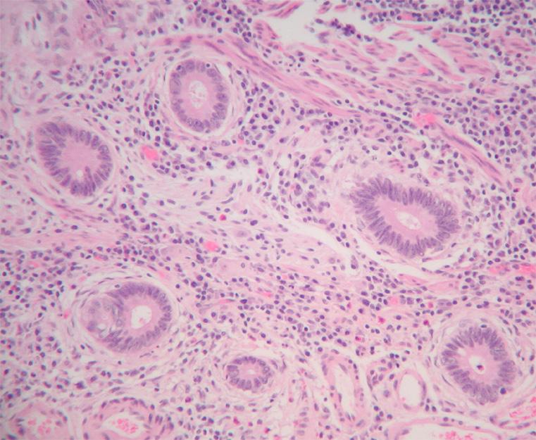 66 Gut and Liver, Vol. 2, No. 2, September 2008 Fig. 2. Invasive low-grade tubuloglandular adenocarcinoma in a patient with ulcerative colitis.