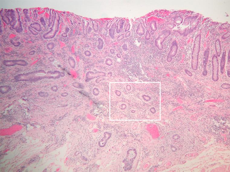 The invasive, malignant glands are well differentiated and manifest rather low-grade cytological features. There is little or no desmoplastic reaction around the glands.