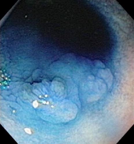 Potack J, et al: Colorectal Cancer in IBD 69 Fig. 4. A slightly raised, but poorly visible flat dysplastic lesion with LGD in a patient with longstanding UC (A).