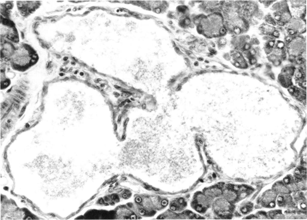 248 D. S. LONGNECKER FIGURE 2. Cystic ductal complex from the pancreas of a rat killed 3 months after injection of MNCO. The cystic spaces are lined by flattened epithelium. H & E, x 325.