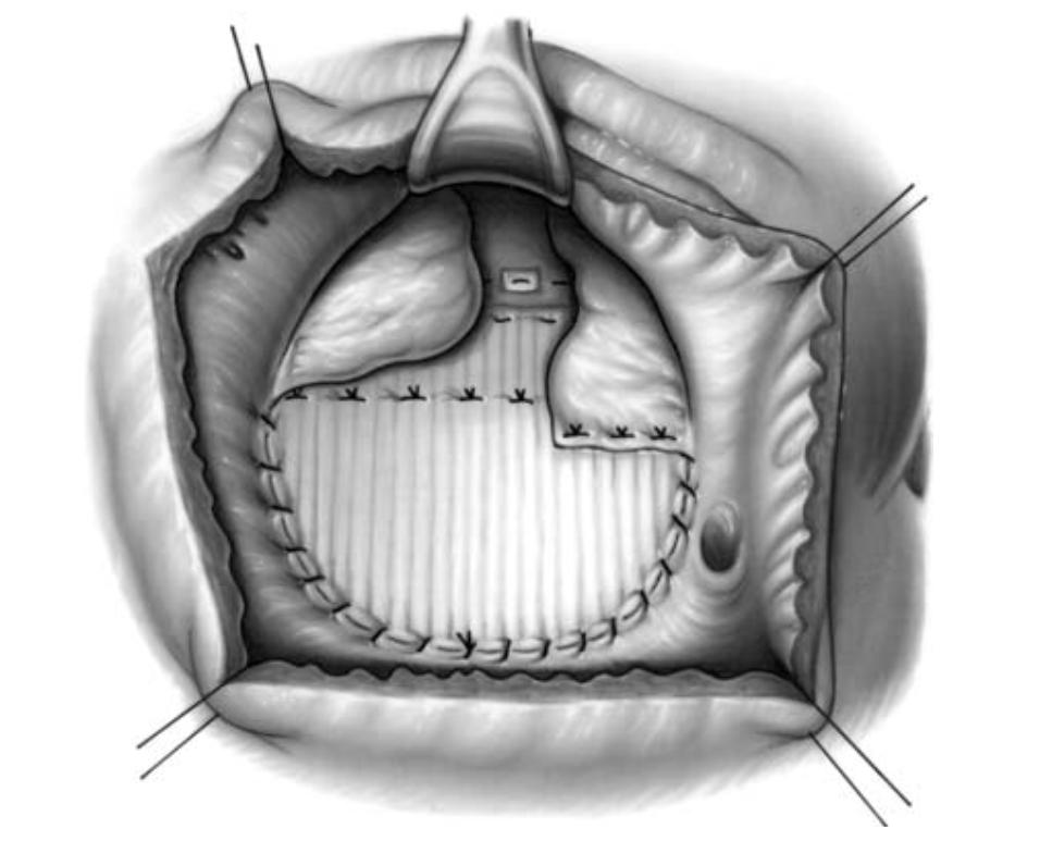 Atrio-ventricular septal defect: Surgery for