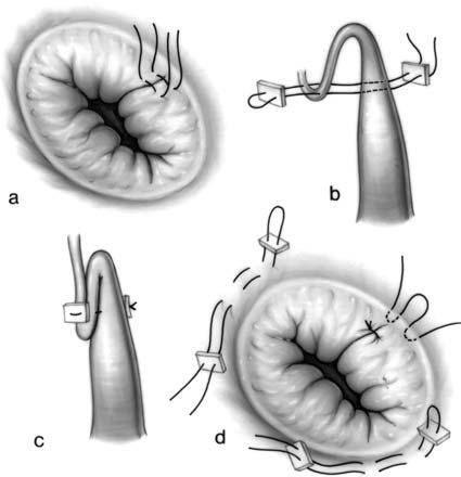 Surgical Treatment mitral valve repair a. Simple commissuroplasty b. Shortening of chordae c. Shortening of chordae (completed) d.