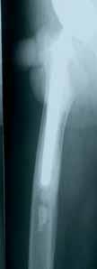An anterior-posterior X ray and a lateral view X ray will be required, showing the femur up to about 15 cm below the distal end of the loosened implant. The templates of a long stem must be used.