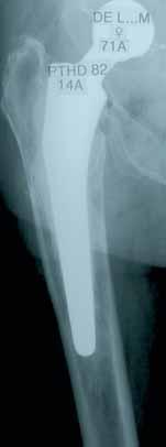 Case Studies (Endofemoral Route) 71-year-old female patient, right THP 1982 (14 years).